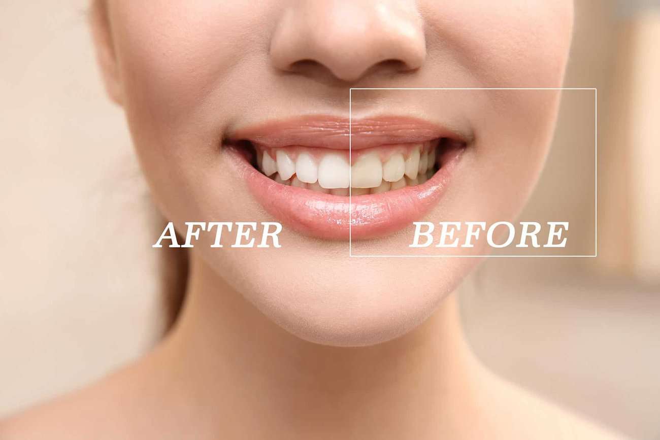 How Can You Maintain a Consistent Smile Shade with Crowns Southport?