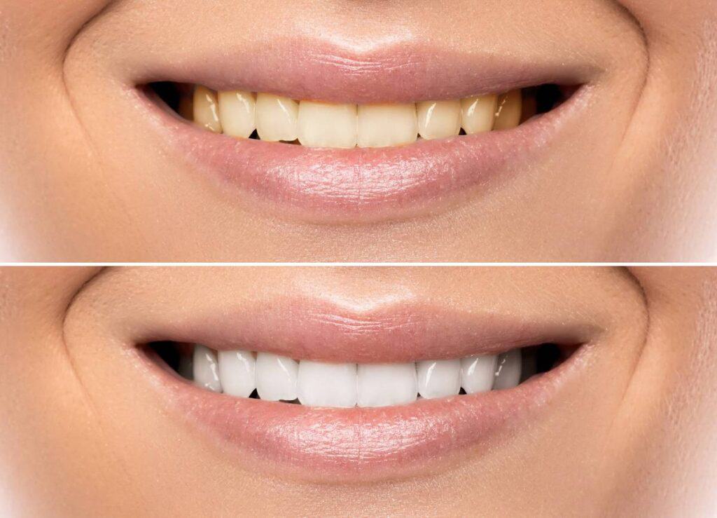 How Can You Protect Your White Smile as a Coffee Lover Southport?