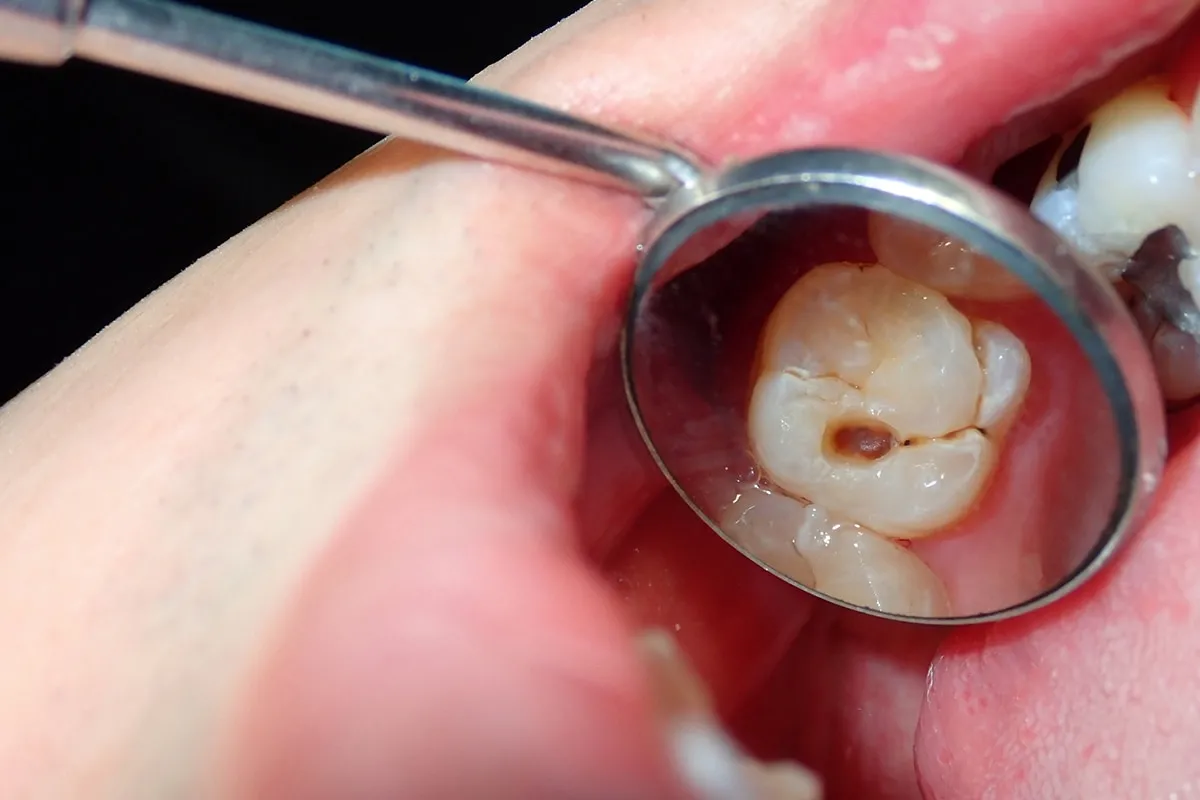 Why Do Teeth Crack? Common Causes to Know Southport