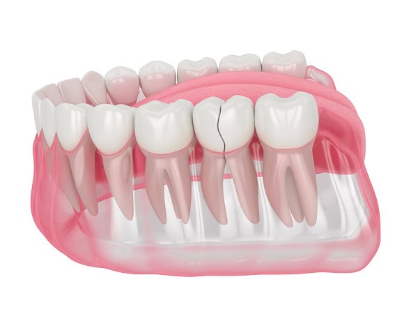 How Can You Manage Pain and Discomfort After a Root Canal Southport?