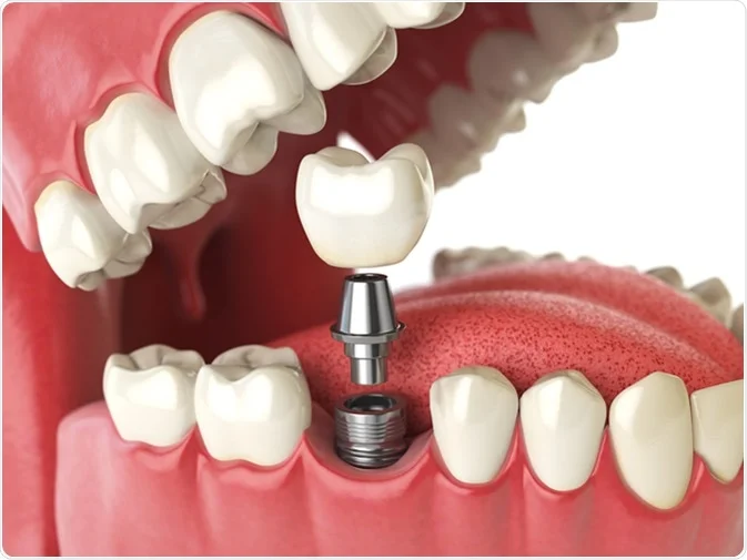 How Do I Decide Which Tooth Replacement Is Right for Me Southport?