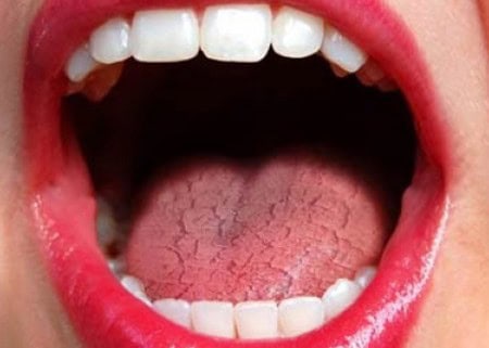 Common Causes of Dry Mouth (Xerostomia) Southport