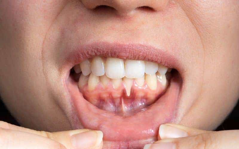 How Can Gum Disease Be Prevented Southport?
