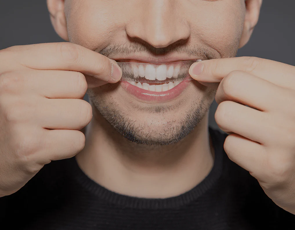 What to Consider Before Choosing a Teeth Whitening Option Southport