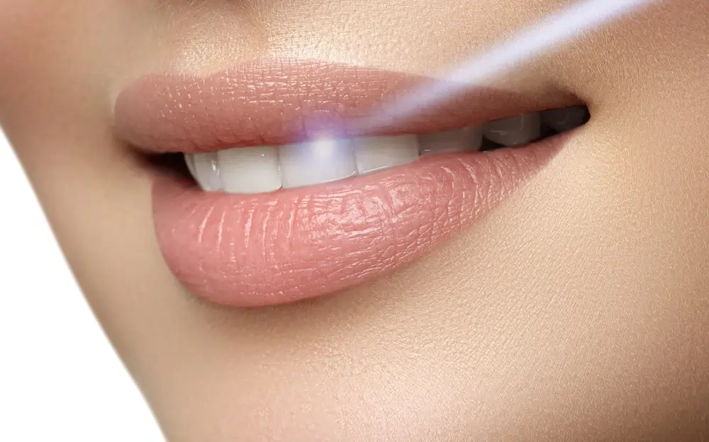 How Long Does Laser Teeth Whitening Last on Your Teeth Southport?