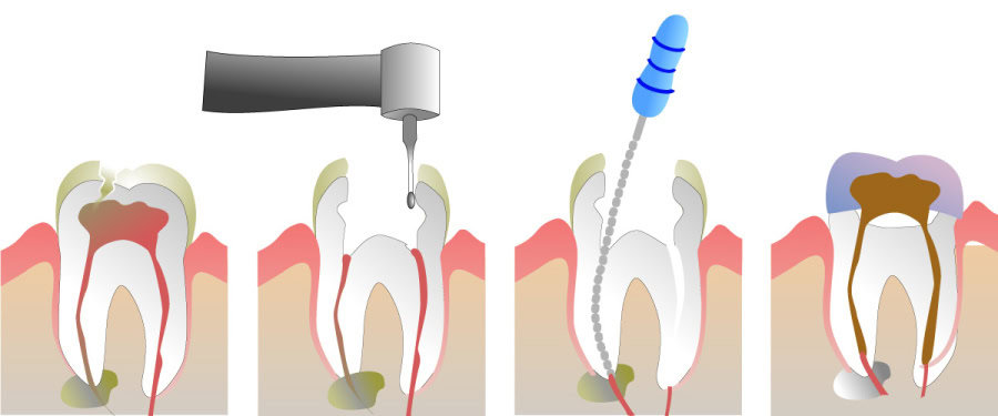 How Do You Properly Care for Your Teeth After a Root Canal Southport