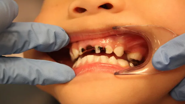 Can Your Diet Help You Achieve a Whiter, Healthier Smile Southport?