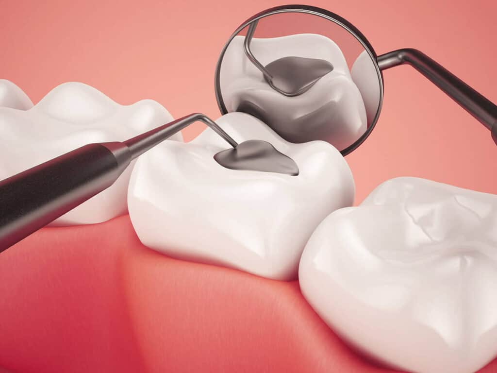 How Can You Prevent Tooth Decay Effectively Southport