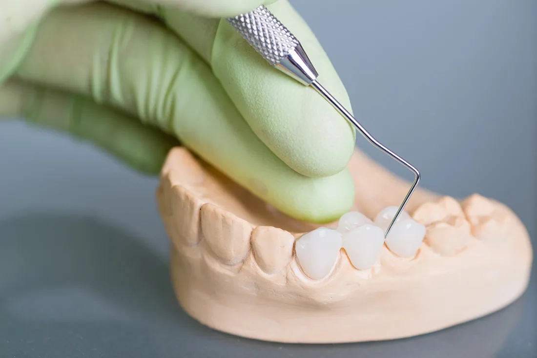 What Are the Different Types of Dental Crowns Available Southport?
