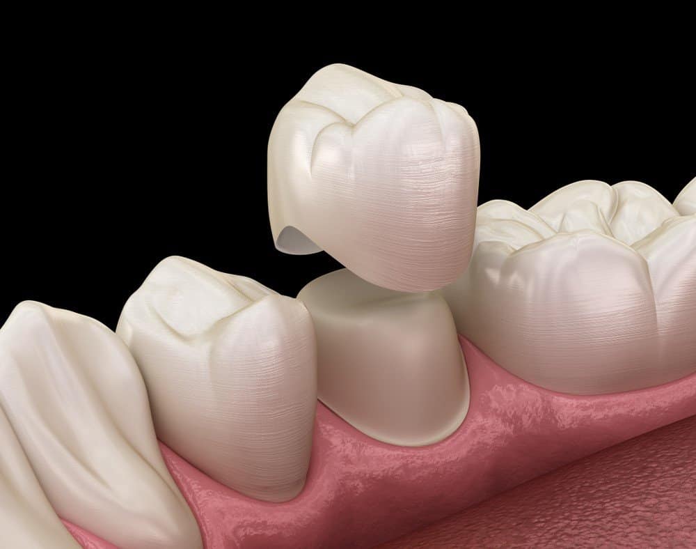 Teeth Whitening: Separating Facts from Fiction Southport