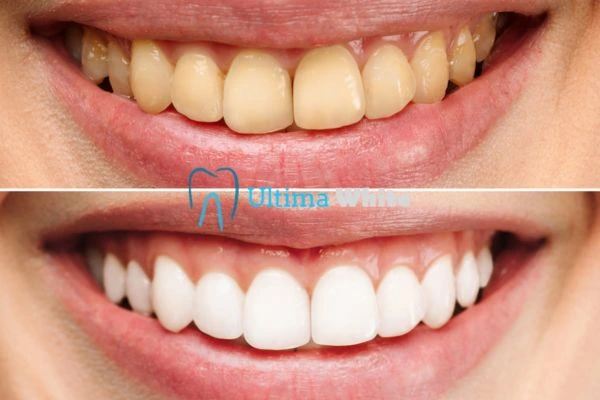 Oral Care Tips for Current and Former Smokers Southport