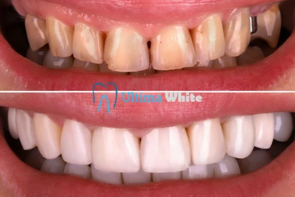What Makes Instant Teeth Whitening Treatments So Popular Southport?