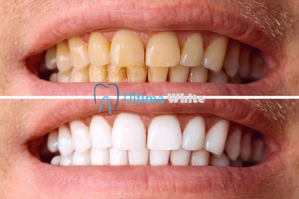 Stained Teeth and Persistent Bad Breath Southport