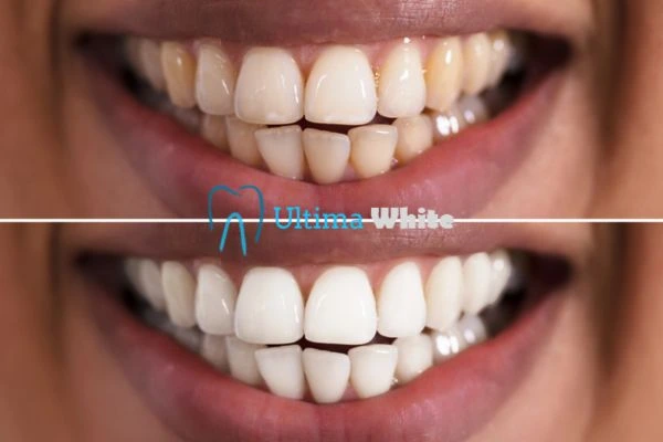 Aftercare Tips to Maintain Your New Smile Southport